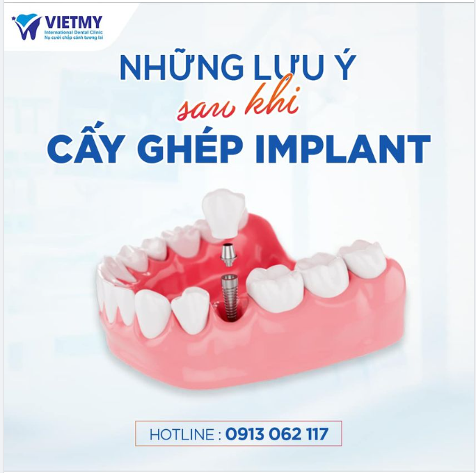 “BỎ TÚI” 8 ĐIỀU NÊN LÀM SAU KHI CẤY GHÉP IMPLANT