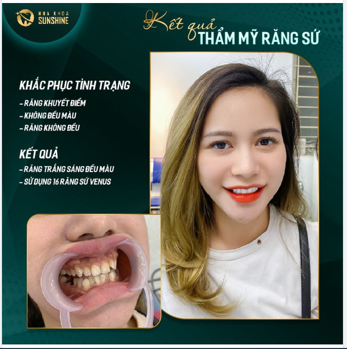 BỌC RĂNG SỨ GIÚP BẠN THAY ĐỔI