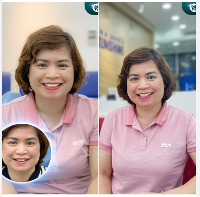 Bọc răng sứ không chỉ mang lại tính thẩm mỹ cho nụ cười mà còn là phương pháp phục hồi chức năng ăn nhai và hạn chế một số bệnh lý về răng miệng.