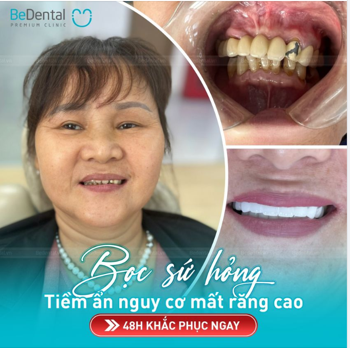 Bọc răng sứ sai cách, tiềm ẩn nguy cơ mất răng cao