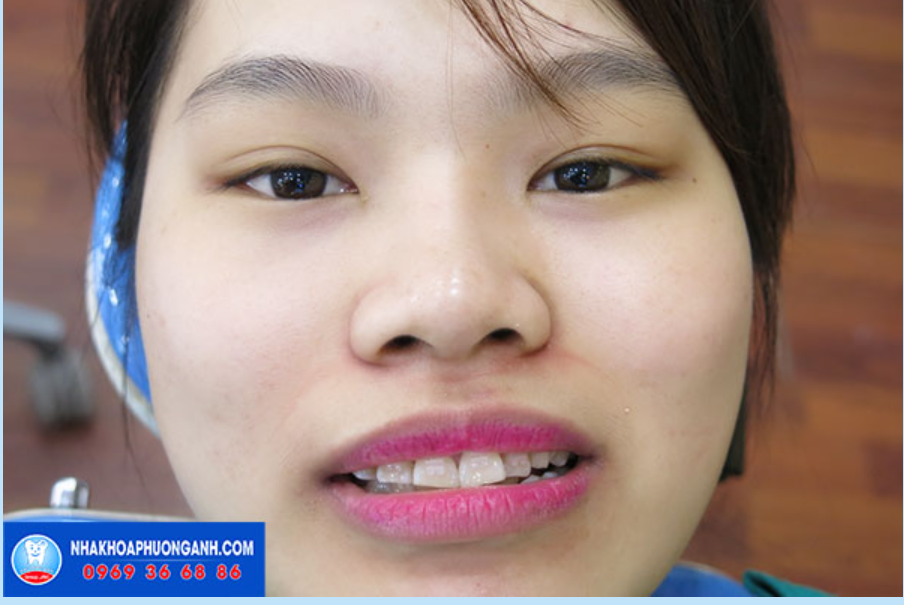 Bọc răng sứ thẩm mỹ thay đổi nụ cười