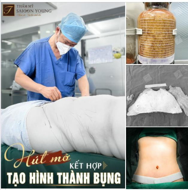 Bụng đầy ngấn mỡ, thân hình sồ sề không cân đối là nỗi ám ảnh lớn đối với nhiều chị em chúng mình.