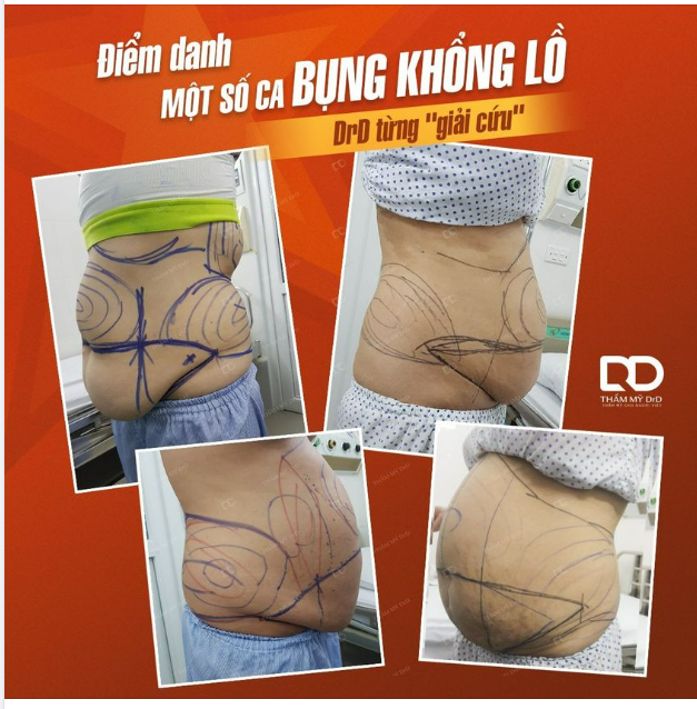 BỤNG KHỔNG LỒ THẾ NÀY... BÁC SĨ CÓ BÓ TAY