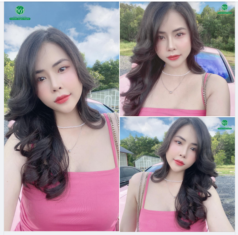 BUỔI SÁNG SẼ LÀ NHỮNG KẾT QUẢ SAU NÂNG MŨI ĐẸP
