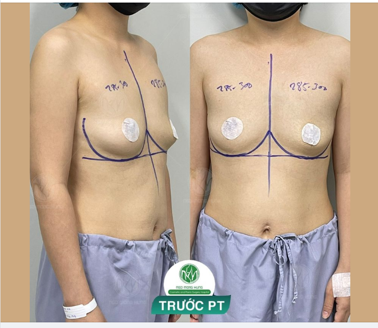 CA ĐẠI PHẪU NÂNG NGỰC CHO SÁNG CHỦ NHẬT