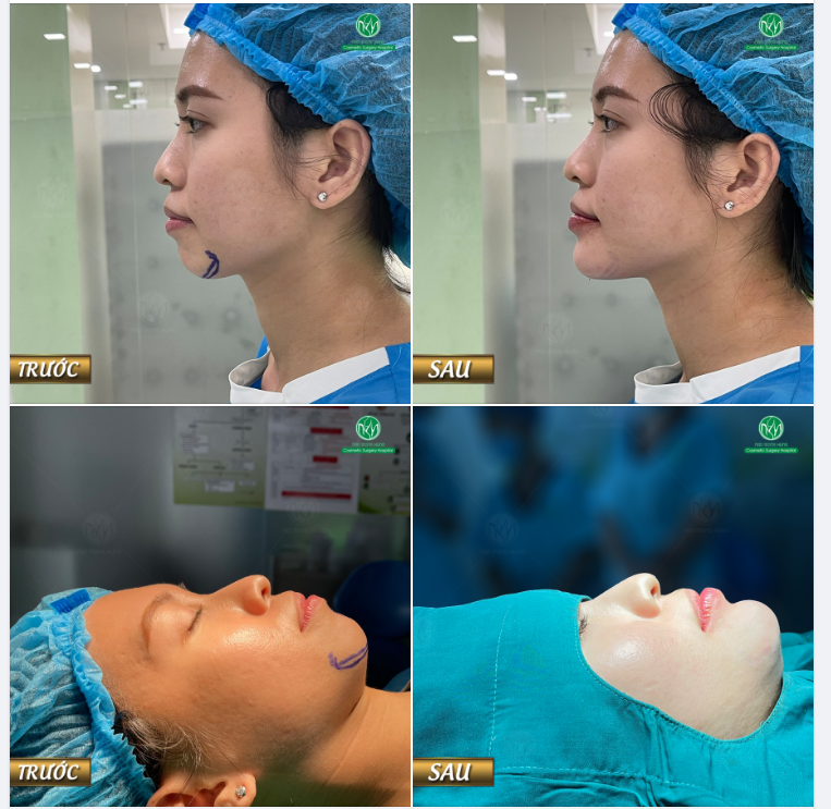 CA ĐỘN CẰM CHO KH CŨ ĐÃ LÀM ĐẸP TẠI BV