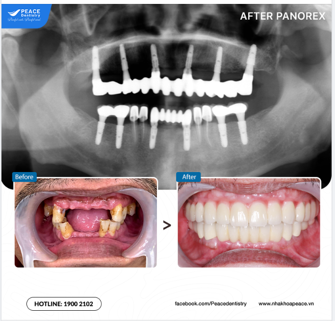 Ca lâm sàng  All on 6 Implant cho hàm trên và cấy ghép 6 Implant thường quy cho hàm dưới...giúp mang lại sự hài lòng trên cả mong đợi với Chú khách hàng lớn tuổi!