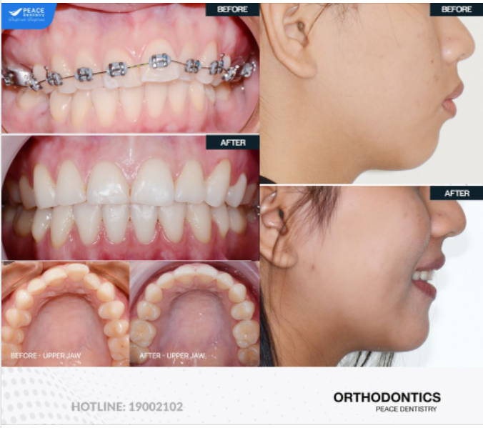 Ca lâm sàng niềng răng mắc cài, cải thiện thẩm mỹ nụ cười và khuôn mặt