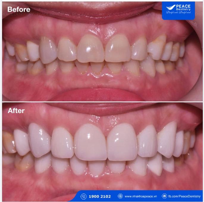 Ca lâm sàng - thiết kế lại nụ cười với mặt dán sứ Veneer