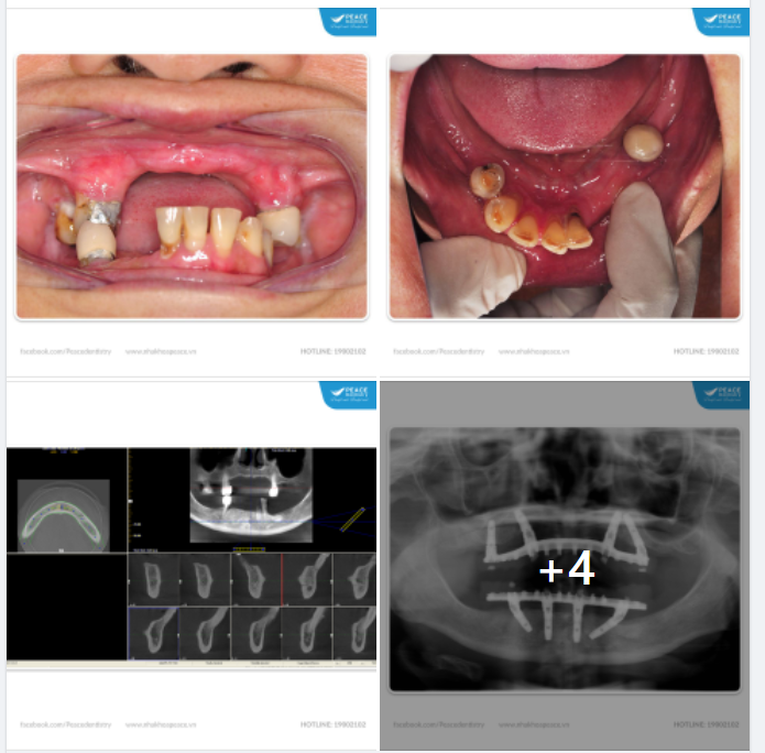 Ca lâm sàng thực hiện bởi bác sĩ chuyên gia ThS.BS Thân Trọng Nguyên và BS. Trần Quang Thái tại Peace Dentistry