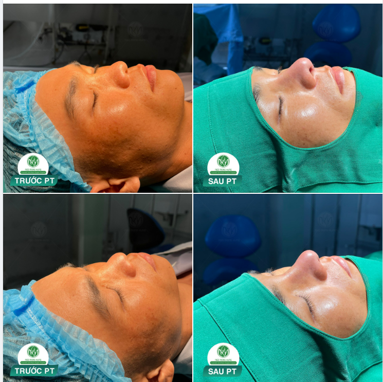 CA NÂNG MŨI CẤU TRÚC KHỞI ĐỘNG NGÀY ĐẦU TUẦN
