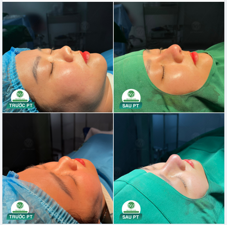 CA NÂNG MŨI S LINE VỪA HOÀN THÀNH TẠI PHÒNG TIỂU PHẪU 2
