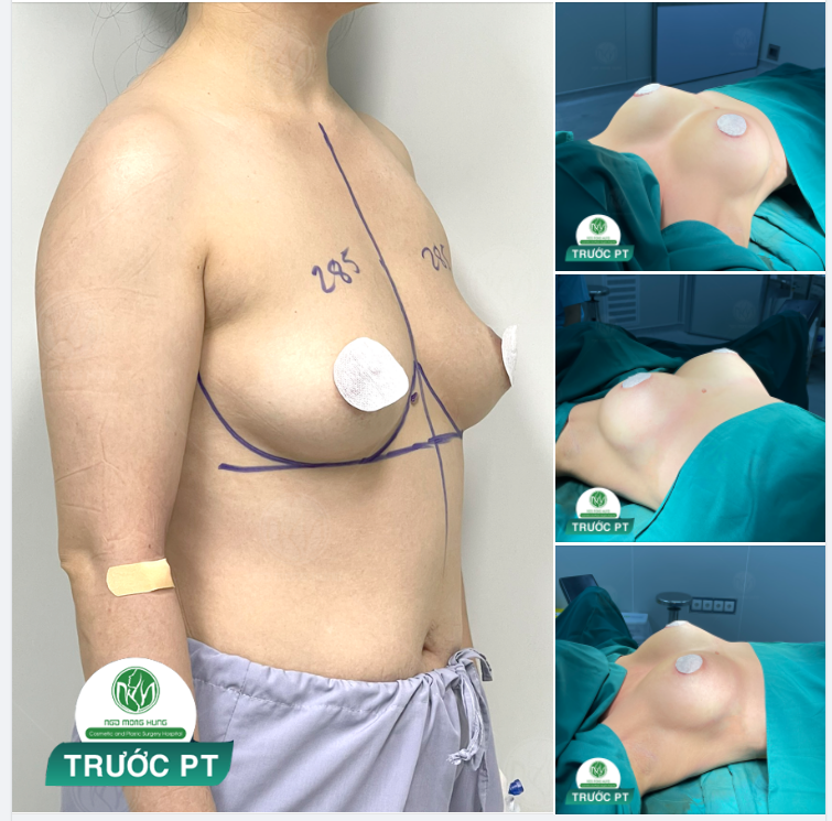 CA NGỰC MỚI NHẤT TẠI BVTM NGÔ MỘNG HÙNG