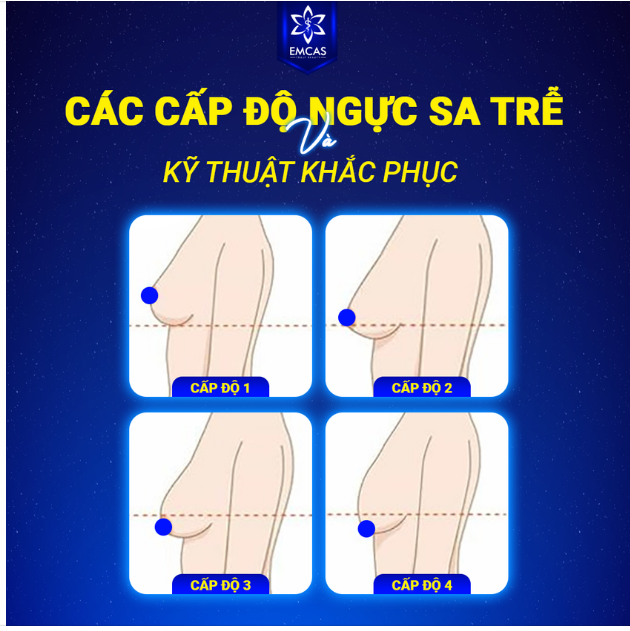 CÁC CẤP ĐỘ NGỰC SA TRỄ VÀ KỸ THUẬT KHẮC PHỤC