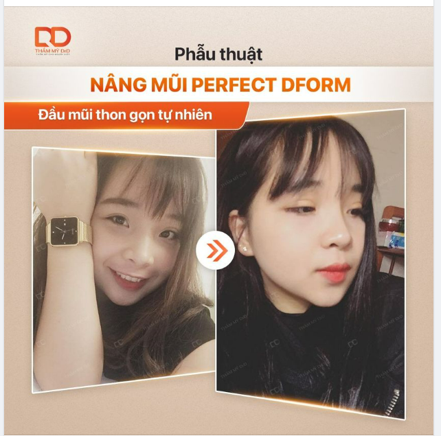 Các nàng ơi, Nâng mũi Perfect Dform GIẢM NGAY 10tr.