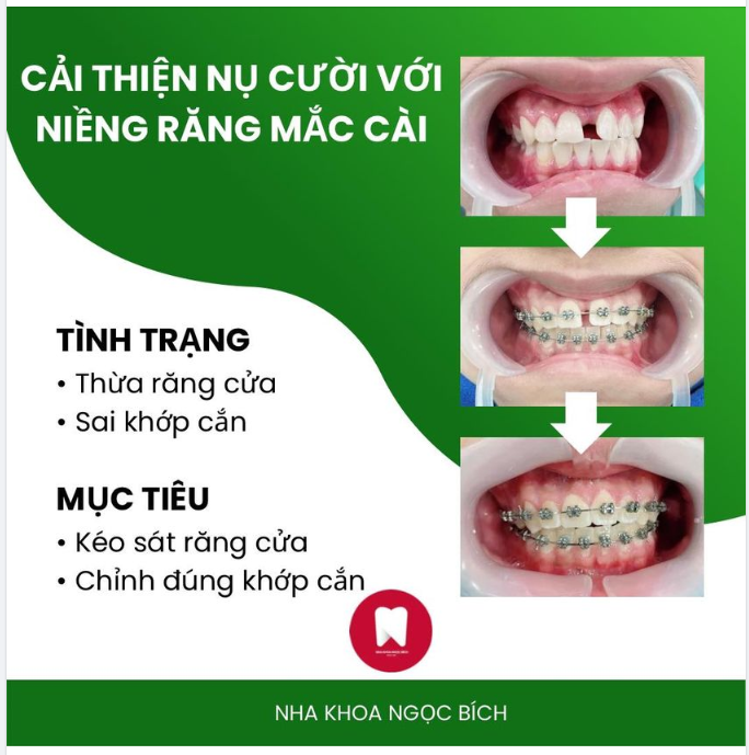 CẢI THIỆN NỤ CƯỜI CÙNG NIỀNG RĂNG MẮC CÀI