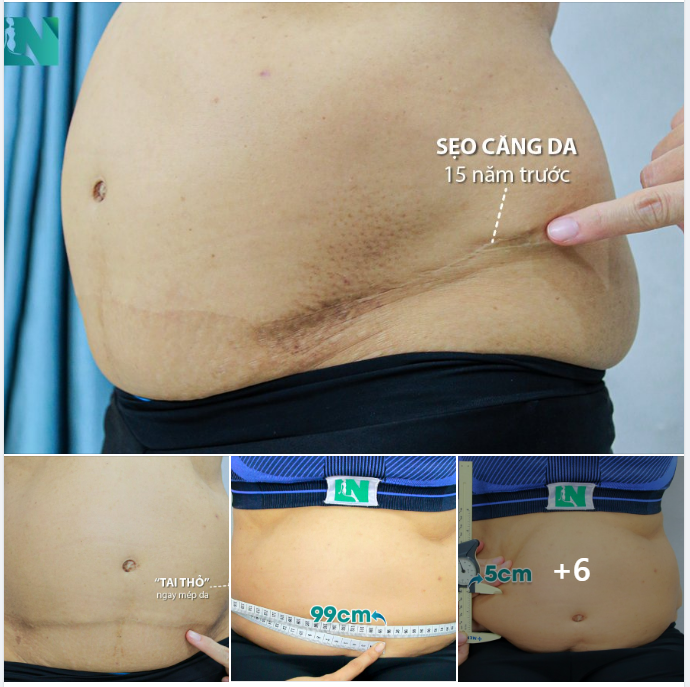 CẢI THIỆN SỨC KHỎE, CẢI THIỆN DÁNG VÓC Ở TUỔI 65 – KH VIỆT KIỀU MỸ CHỌN HÚT MỠ TẠO DÁNG THẨM MỸ, CẤY MỠ NGỰC. TRỰC TIẾP 15H30 – 16H30 HÔM NAY