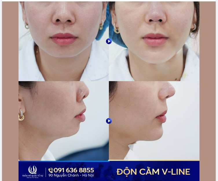 Cằm thon gọn - Giữ trọn sắc xuân. Cùng Độn cằm V–Line 
