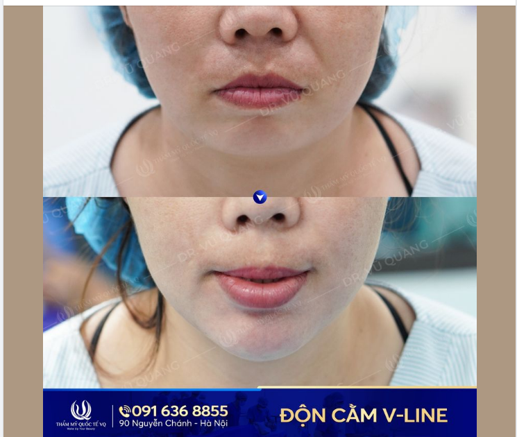 Cằm xinh yêu kiều, triệu người phải ngắm