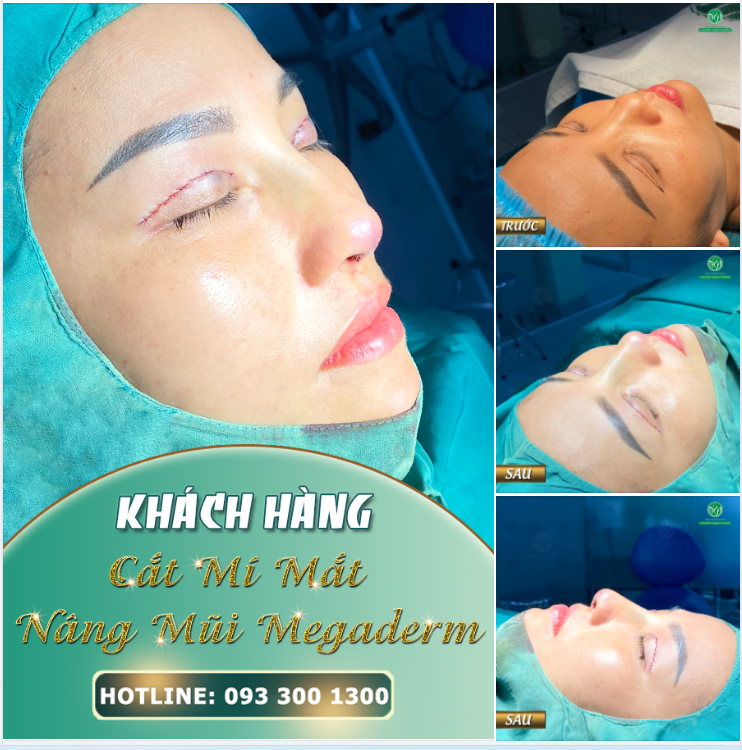 CẬN CẢNH KẾT QUẢ COMBO CẮT MÍ + NÂNG MŨI MEGADERM