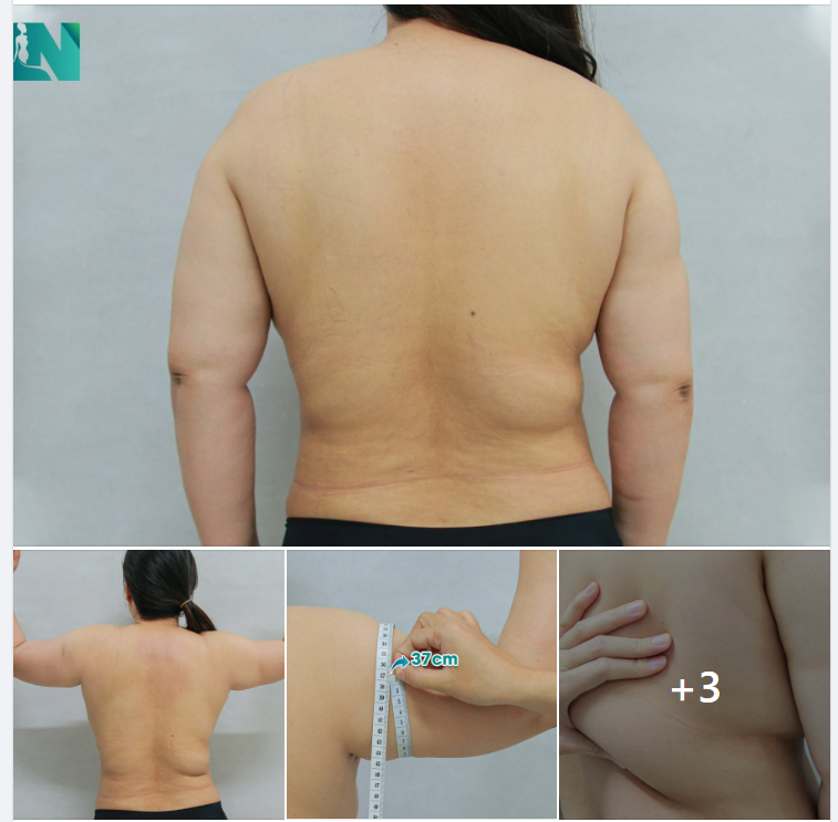 CÂN ĐỐI DÁNG VÓC VỚI HÚT MỠ ĐỢT 2 VÙNG TAY, LƯNG, NÁCH, CẤY MỠ NGỰC TỰ THÂN CHO CHỊ KH ĐẾN TỪ BÌNH DƯƠNG, TRỰC TIẾP 15H30 – 16H30 HÔM NAY