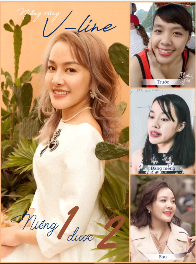 CẦN GÌ PHẢI PHẪU THUẬT KHI MÀ NIỀNG RĂNG ĐÃ LÀM ĐƯỢC TẤT CẢ