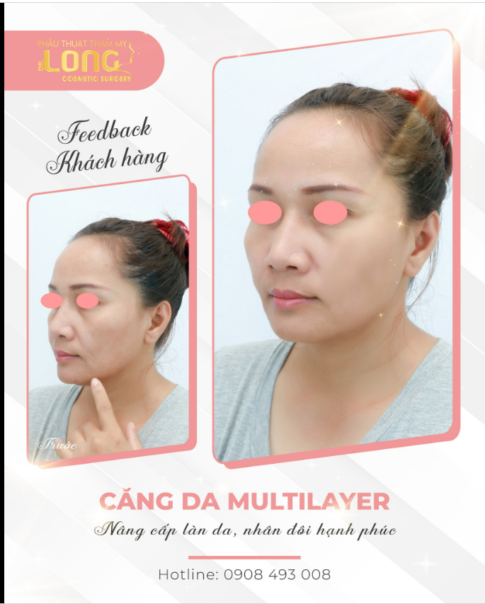 CĂNG DA MẶT TRẺ RA 5, 10 TUỔI HIỆU QUẢ 90% NGAY LẦN ĐẦU THỰC HIỆN