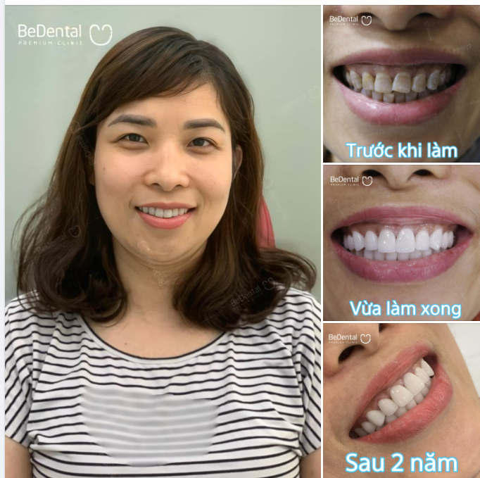 "Càng ngày, răng chị càng đẹp hơn hay sao ấy" - Khách hàng sau 2 năm thẩm mỹ răng sứ quay trở lại be tái khám