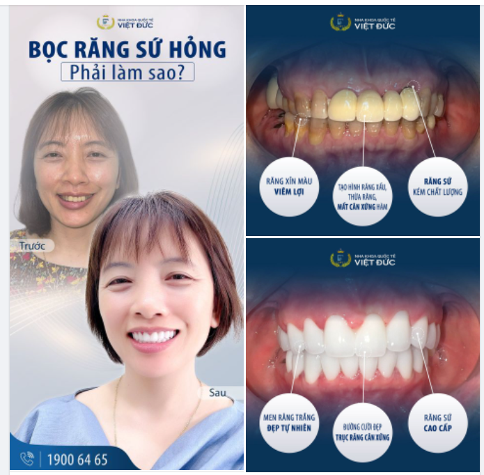 “CẤP CỨU” NỤ CƯỜI BUỒN VÌ SAI LẦM CHỌN RĂNG SỨ GIÁ RẺ