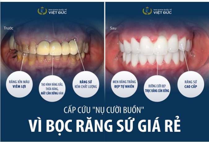“CẤP CỨU” NỤ CƯỜI VÌ SAI LẦM CHỌN RĂNG SỨ GIÁ RẺ