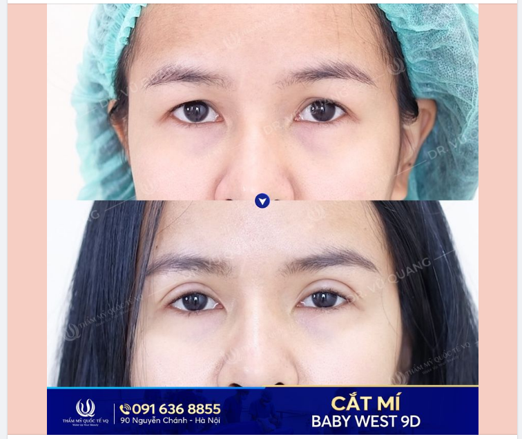 Cắt mí Baby West 9D - Cắt mí không chảy máu - Độc quyền tại Thẩm mỹ quốc tế VQ.
