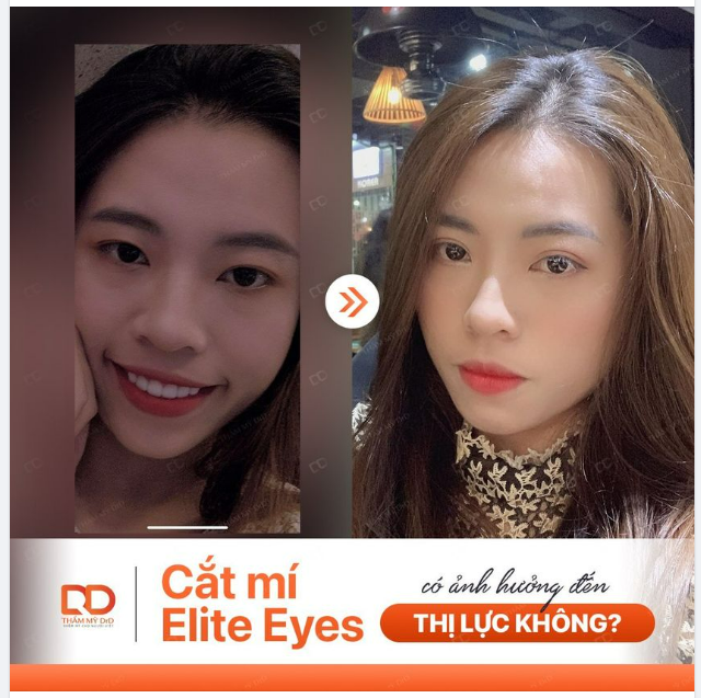 CẮT MÍ ELITE EYES CÓ ẢNH HƯỞNG ĐẾN THỊ LỰC