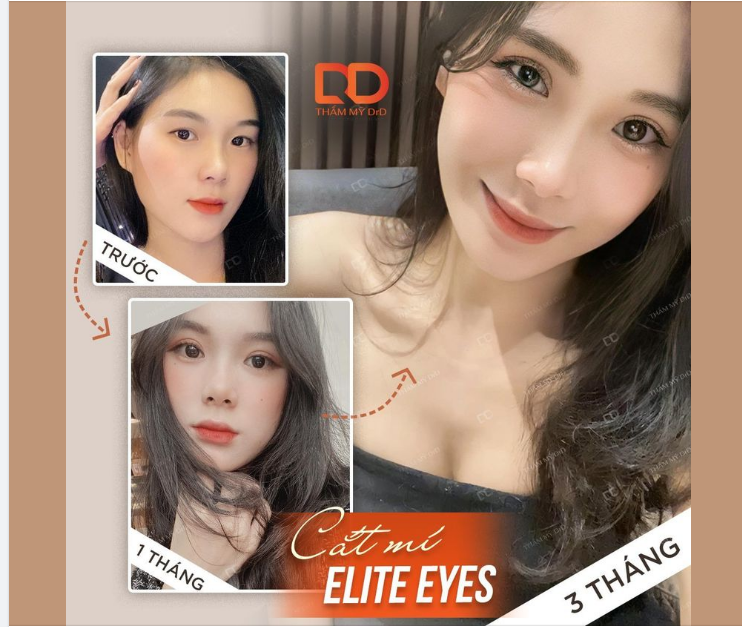 CẮT MÍ ELITE EYES CÓ BAO GỒM BÓC MỠ MẮT