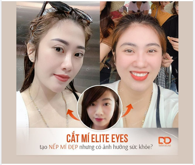 CẮT MÍ ELITE EYES TẠO NẾP MÍ ĐẸP NHƯNG CÓ ẢNH HƯỞNG ĐẾN SỨC KHỎE