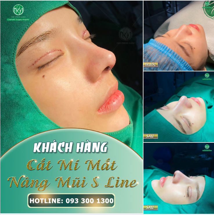 CẮT MÍ KẾT HỢP NÂNG MŨI - MANG LẠI VẺ ĐẸP HOÀN THIỆN CHO KHUÔN MẶT