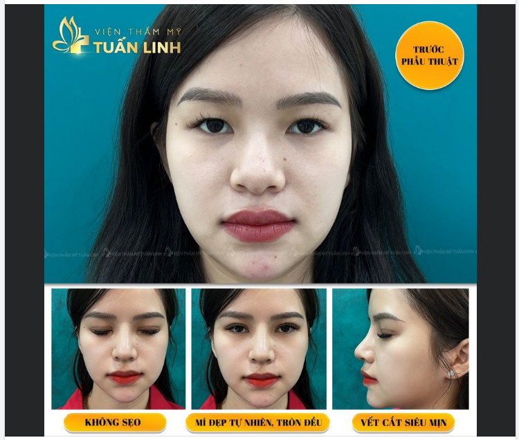 Cắt mí không sẹo - Nếp mí siêu tự nhiên