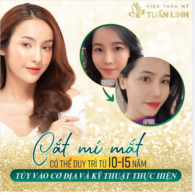 CẮT MÍ MẮT GIỮ ĐƯỢC BAO LÂU