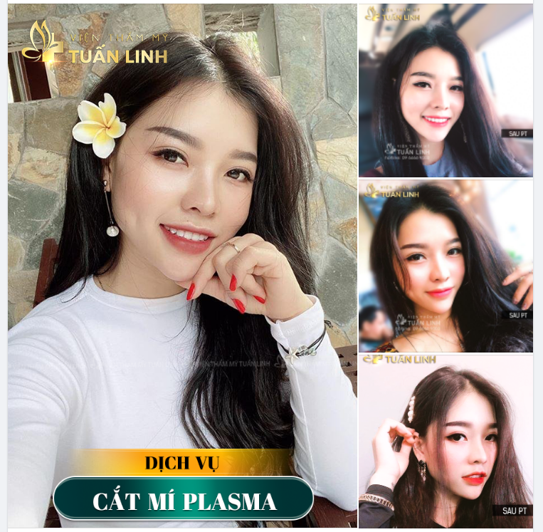 CẮT MÍ PLASMA - ĐIỂM NHẤN NHỎ CHO ĐÔI MẮT ĐẸP HÚT HỒN