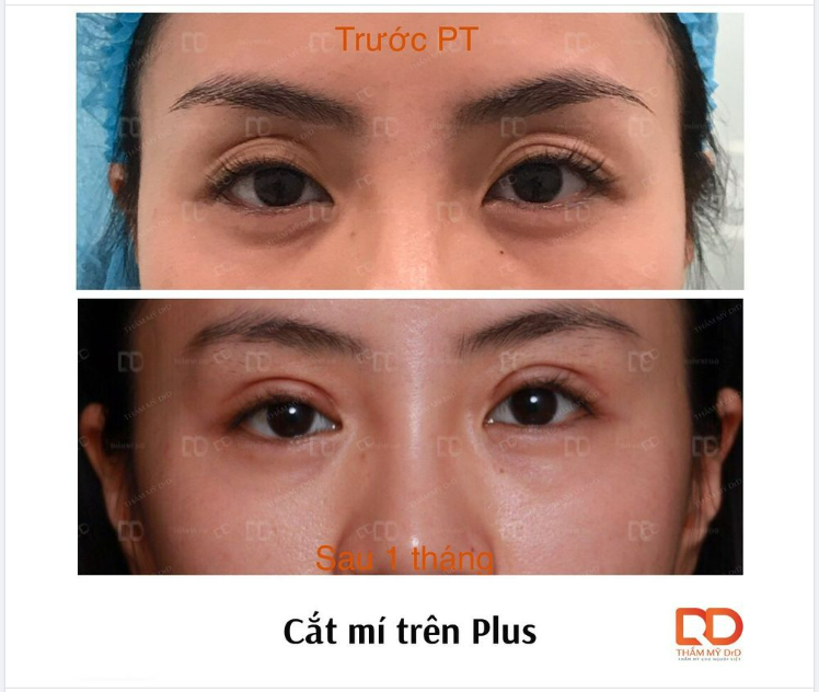 Cắt mí Plus giúp chỉnh sửa toàn diện các vấn đề thẩm mỹ mắt, tạo nếp mí trên mới sắc nét, tự nhiên.
