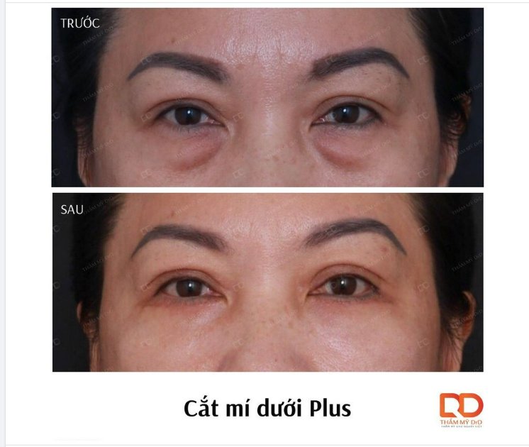 Cắt mí Plus không loại bỏ bọng mỡ mắt mà chuyển dịch đến vùng lõm để lấp đầy chỗ trũng, trẻ hóa đôi mắt, tìm lại thanh xuân cho phái dẹp tuổi trung niên.