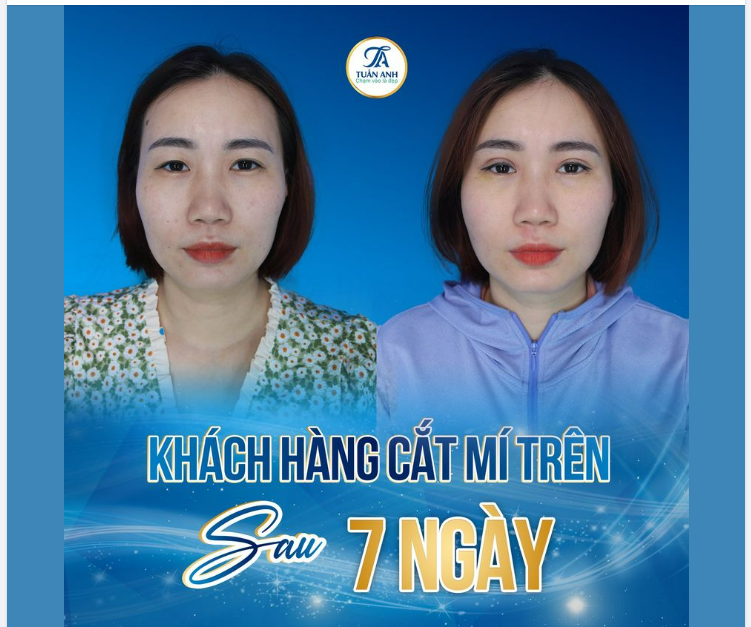 CẮT MÍ TRÊN ĐEM LẠI NHỮNG HIỆU QUẢ GÌ