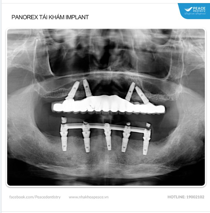 Cấy ghép Implant All-on-4 hàm trên và All-on-5 hàm dưới giúp khôi phục trọn vẹn chức năng ăn nhai và thẩm mỹ răng miệng