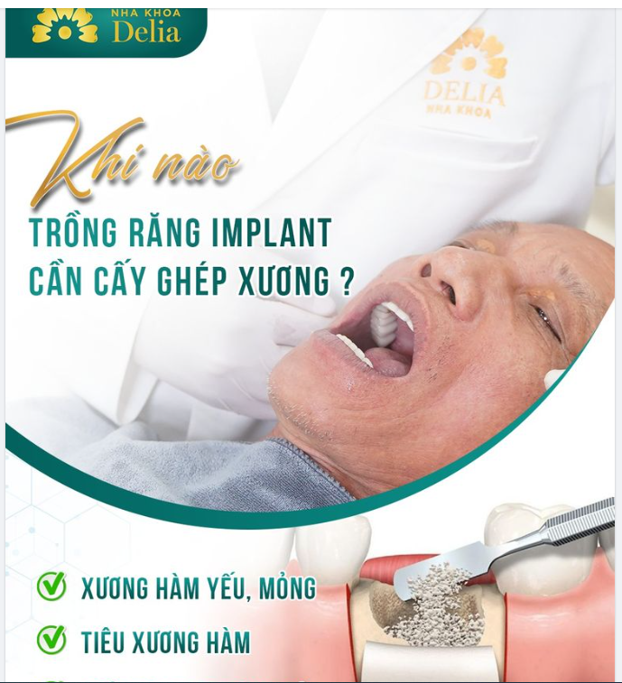 Cấy ghép xương - Kỹ thuật quan trọng trong trồng răng Implant