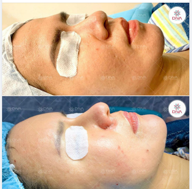 CẤY MỠ COLEMAN MẶT CÓ LỢI CHO LÀN DA - BẠN BIẾT CHƯA