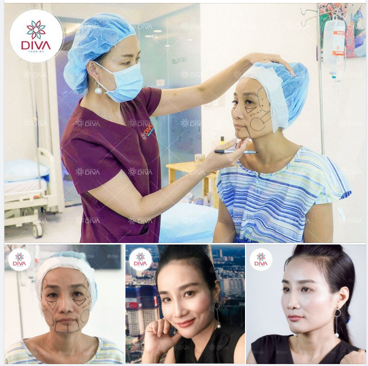 CẤY MỠ COLEMAN, NÂNG MŨI MẶT ĐẸP TINH TẾ, HÀI HÒA