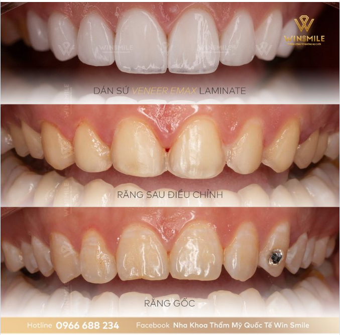 CHẲNG CẦN MÀI, RĂNG VẪN ĐẸP HOÀN MỸ