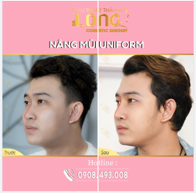 CHÀNG THÊM TỰ TIN NHỜ NÂNG MŨI XỊN​​​​​​​ INBOX HÔM NAY GIÁ ƯU ĐÃI