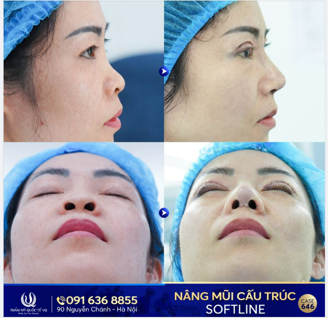 Chỉ 60p nâng mũi cấu trúc Softline đã mang lại sự khác biệt vô cùng lớn cho chị Thương - KH đến từ Quảng Ninh