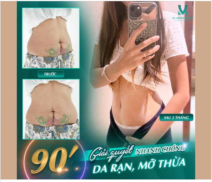 Chỉ 90P - Rạn da, mỡ thừa không còn đeo bám bạn nữa