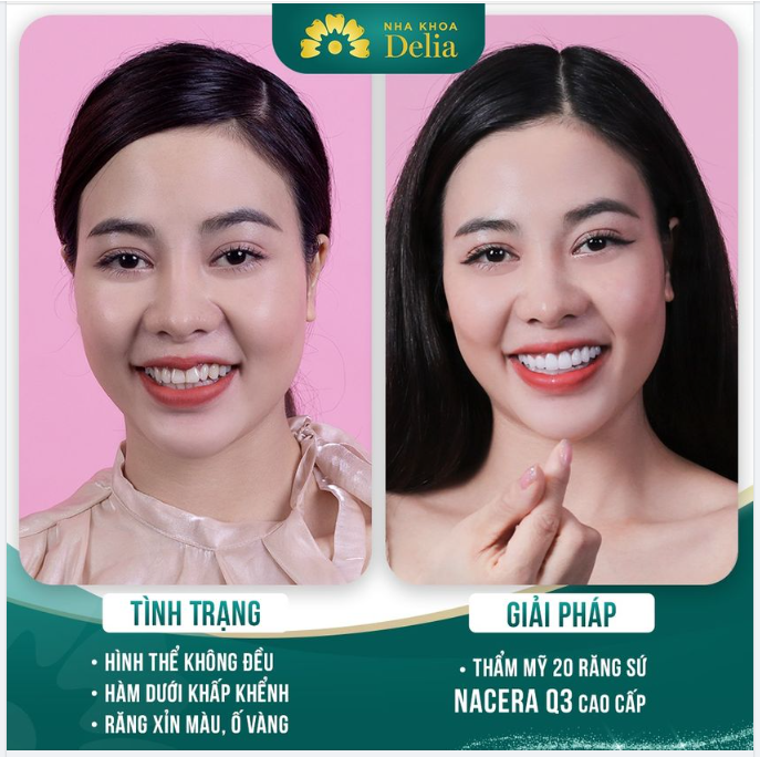 Chị Bảo Trâm chia sẻ với Delia tình trạng răng không đều, khấp khểnh và ố vàng khiến chị khó tự tin.